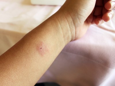 עונת העקיצות כבר כאן!