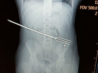 אאוץ': שלפו צלצל מבטנו של צעיר טברייני